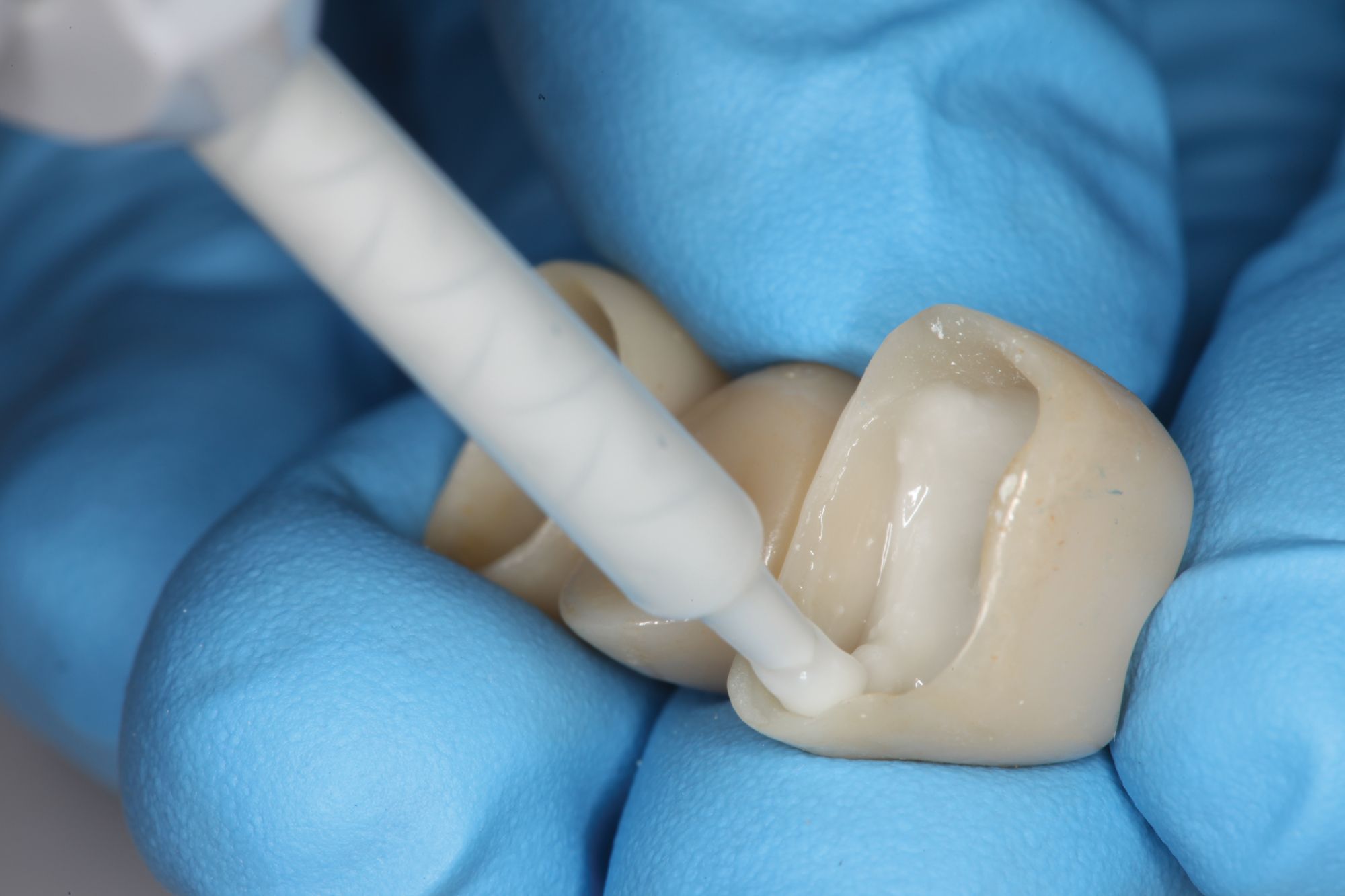 The ResinModified Glass Ionomer Cement Is Here